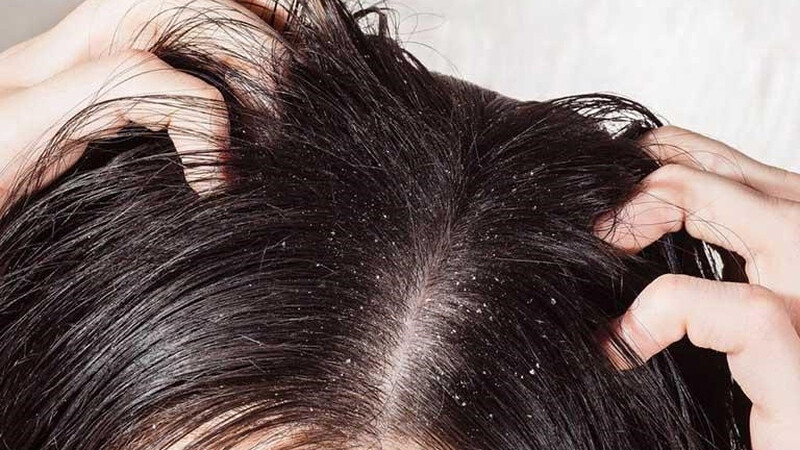 Tại sao gội đầu xong vẫn có gàu? Da đầu dầu là môi trường lí tưởng cho gàu nhiều.