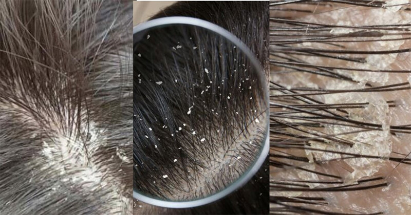 Cách khắc phục tình trạng gội đầu xong vẫn có gàu.