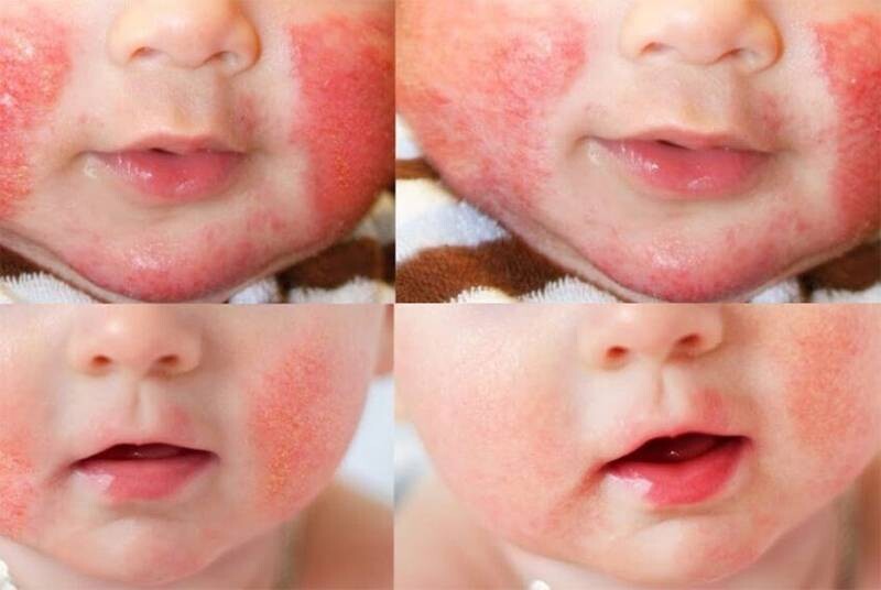 Chàm sữa có thể là nguyên nhân khiến trẻ sơ sinh nổi mẩn đỏ khắp người.