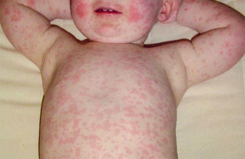 Trẻ sốt xong bị mẩn đỏ có sao không? Nguyên nhân và cách xử lý 3 - 3 Nguyên nhân trẻ sốt xong bị mẩn đỏ phổ biến nhất là do sốt phát ban.
