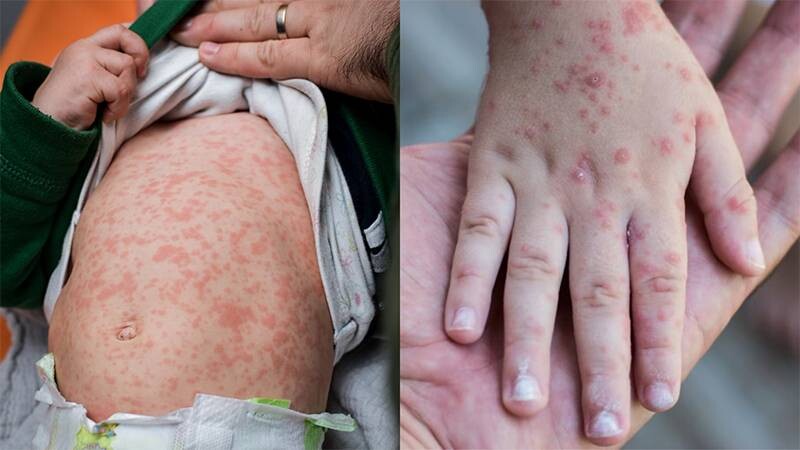 Trẻ sốt xong bị mẩn đỏ có sao không? Nguyên nhân và cách xử lý 4 - 4 Bệnh Rubella cũng là một trong những nguyên nhân khiến trẻ sốt xong bị mẩn đỏ.
