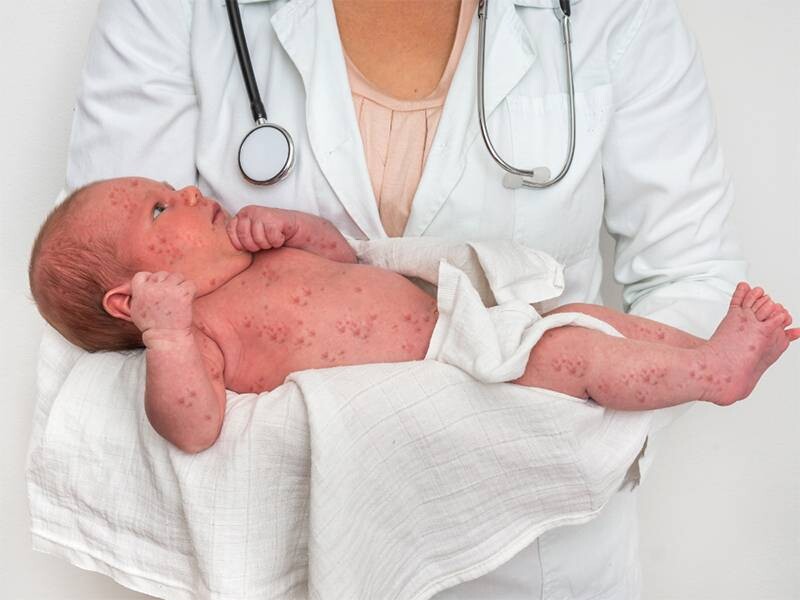 Trẻ sốt xong bị mẩn đỏ có sao không? Nguyên nhân và cách xử lý 5 - 5 Khi nào hết sốt nổi mẩn đỏ ở trẻ em cần đi khám ngay?