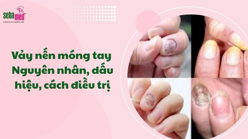 Vảy nến móng tay: Nguyên nhân, dấu hiệu, cách điều trị.