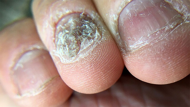 Vảy nến móng tay có nguy hiểm không?