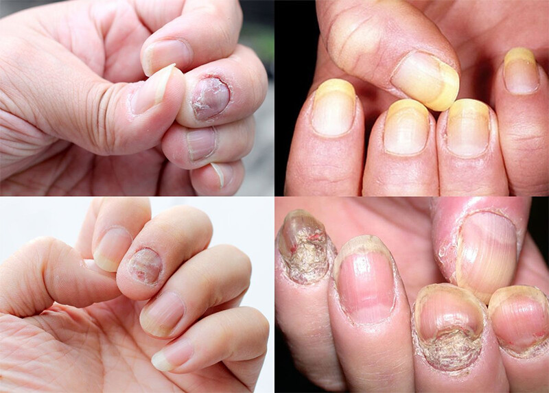 Cách chữa vảy nến móng tay theo khoa học.