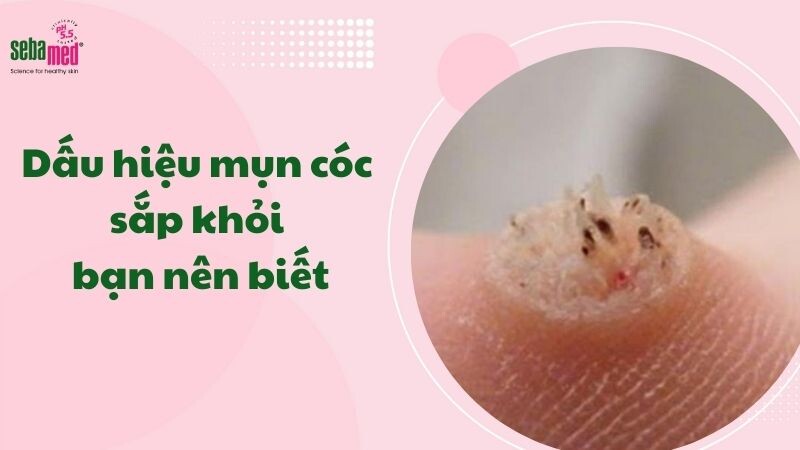 Dấu hiệu mụn cóc sắp khỏi bạn nên biết để tránh tái phát.