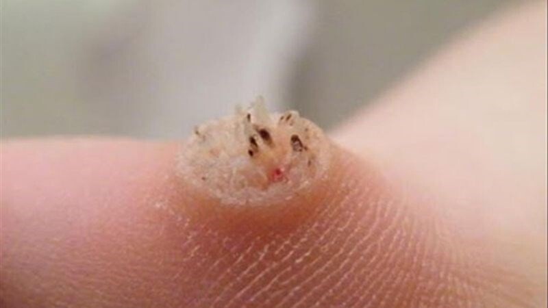 Mụn cóc là gì? Dấu hiệu mụn cóc sắp khỏi là gì?