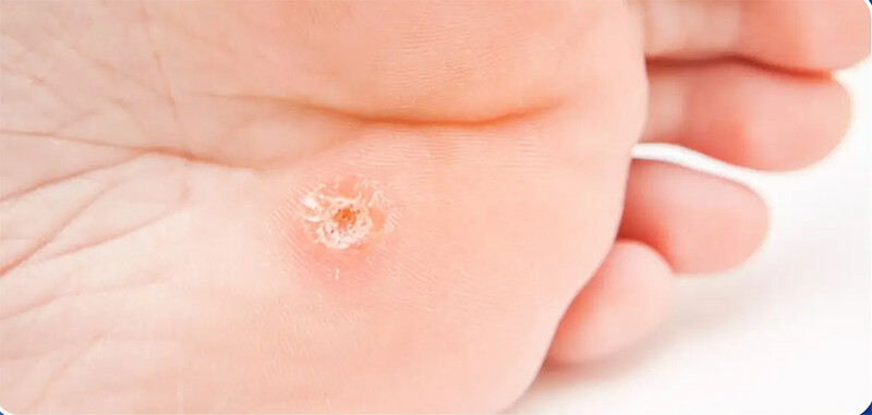 Những lưu ý với các dấu hiệu mụn cóc sắp khỏi.