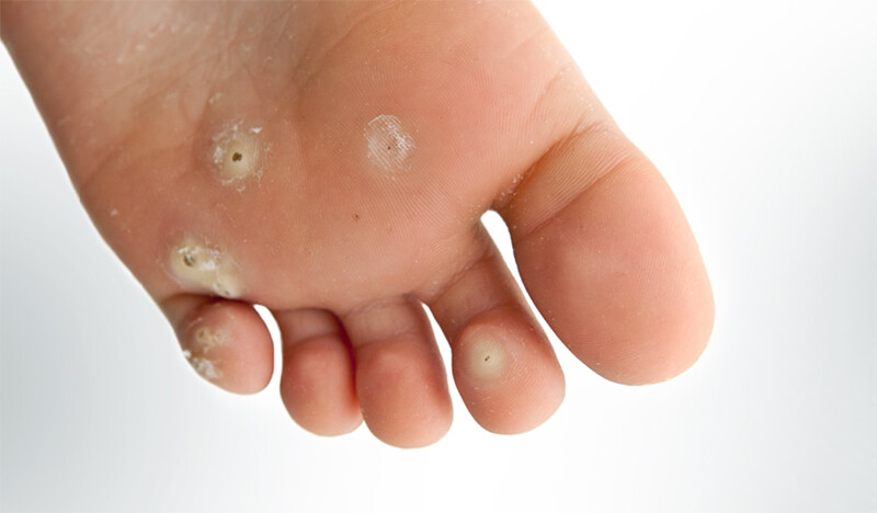Mụn cóc có đau không? Mụn cóc ở lòng bàn chân thường gay đau phổ biến nhất.