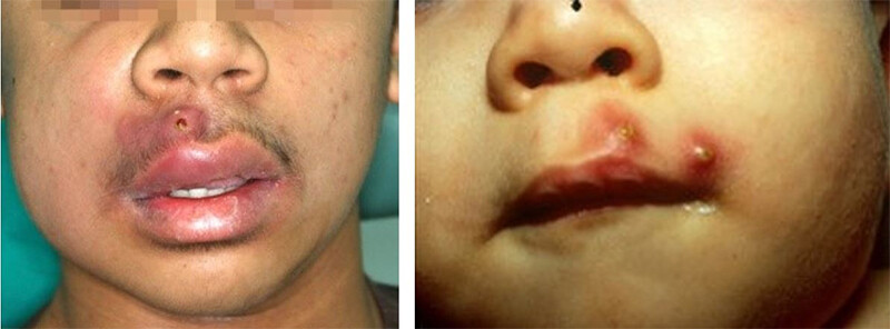 Mụn đinh râu là gì? Mụn đinh râu có nặn được không?