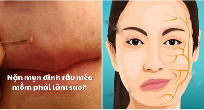 Nặn mụn đinh râu có méo mồm không?