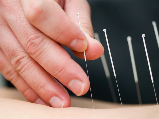 Châm cứu có thể giúp giảm ngứa ở những người bị bệnh chàm.