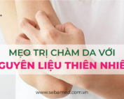 mẹo trị chàm da