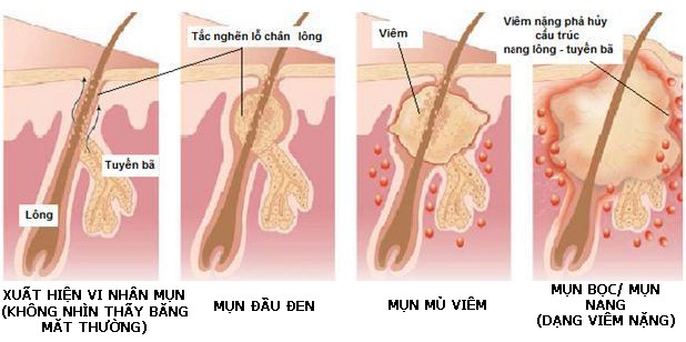 Nguyên nhân gây mụn và cách chăm sóc da mụn – www.sebamed.com.vn