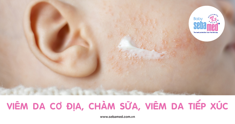 Hình ảnh chàm sữa ở trẻ sơ sinh