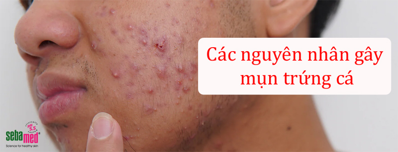 Những nguyên nhân gây mụn trứng cá xuất hiện phổ biến - 2 - sebamed Mụn trứng cá là gì? Tìm hiểu các nguyên nhân mọc mụn trứng cá.