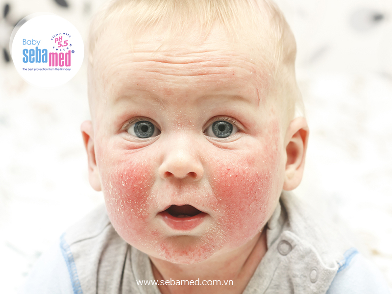 Chàm sữa: nguyên nhân và cách điều trị cho trẻ - sebamed Những Sai Lầm Của Mẹ Khi Bé Bị Chàm Sữa