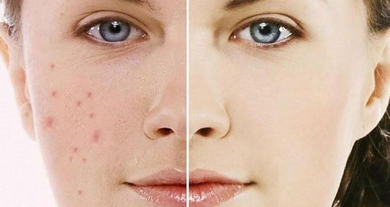 Cách trị thâm mụn hiệu quả sau một đêm