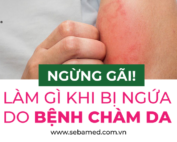 Bệnh chàm da
