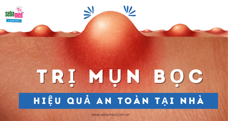 Cách Trị Mụn Bọc Hiệu Quả An Toàn Tại Nhà