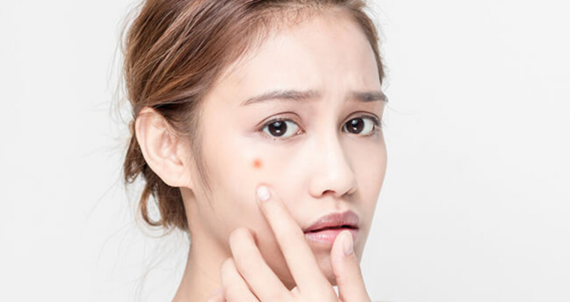 6 mẹo trị mụn trứng cá an toàn và hiệu quả