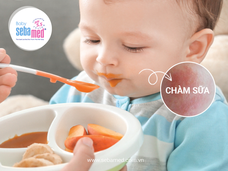Mối liên quan giữa ăn uống và chàm sữa