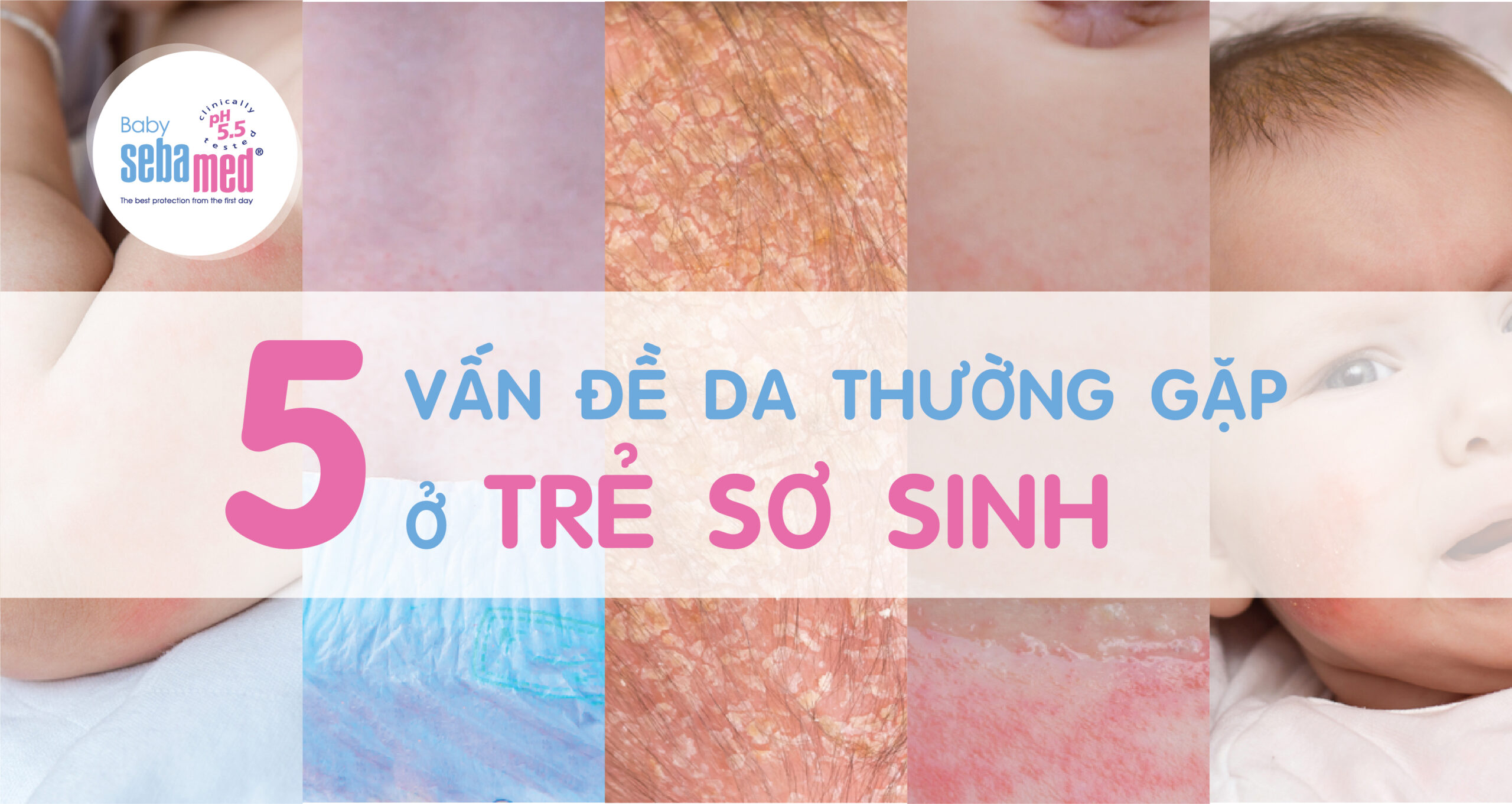 Các bệnh về da ở trẻ sơ sinh thường gặp