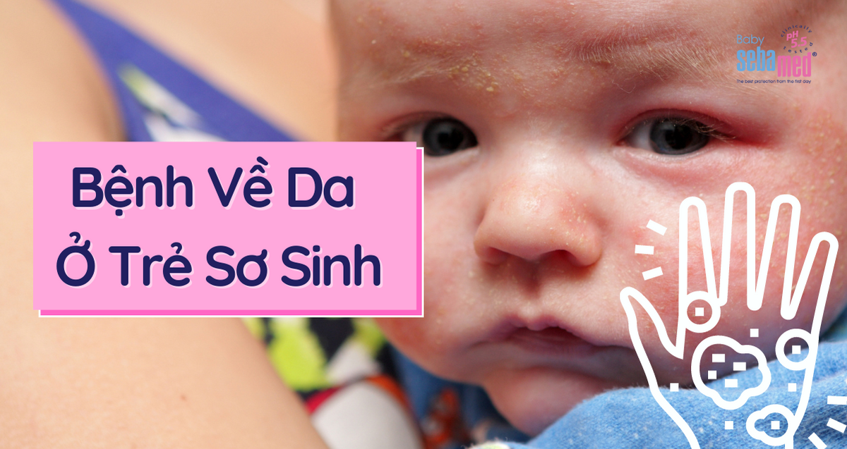 Bệnh Về Da Ở Trẻ Sơ Sinh