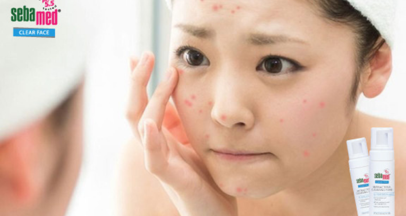 Nguyên Nhân Gây Mụn Và Cách Chăm Sóc Da Mụn