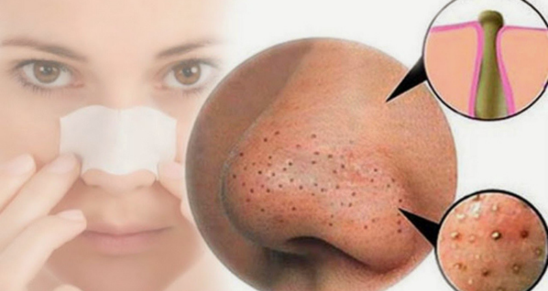 8 Cách trị mụn đầu đen nhanh chóng dễ làm tại nhà