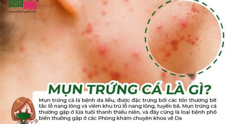5 Loại mụn trứng cá thường gặp nhất có thể bạn chưa biết