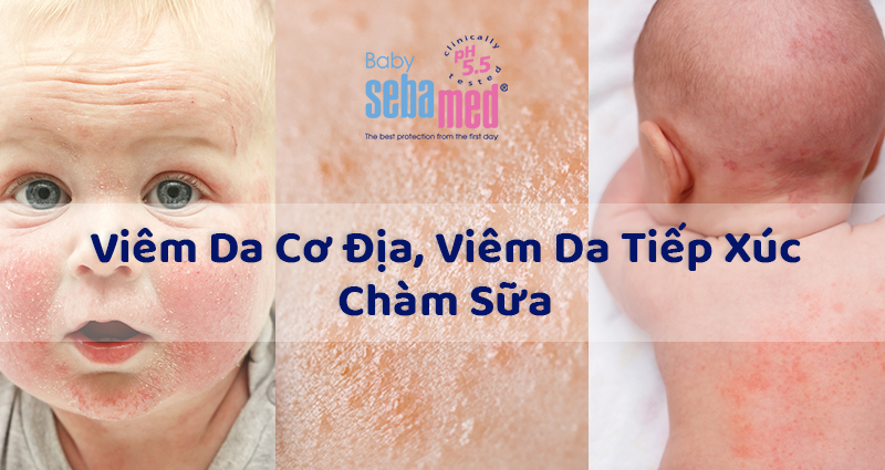 Viêm Da Cơ Địa, Chàm Sữa, Viêm Da Tiếp Xúc