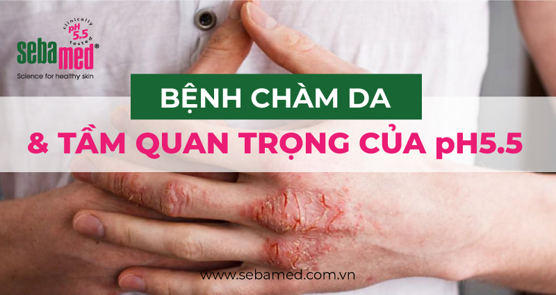 Bệnh Chàm Da Và Tầm Quan Trọng Của pH5.5
