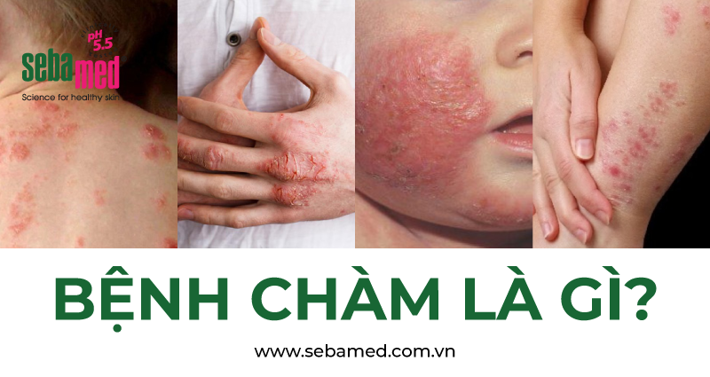 Bệnh Chàm là gì?