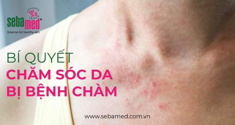 Bí Quyết Chăm Sóc Da Bị Bệnh Chàm