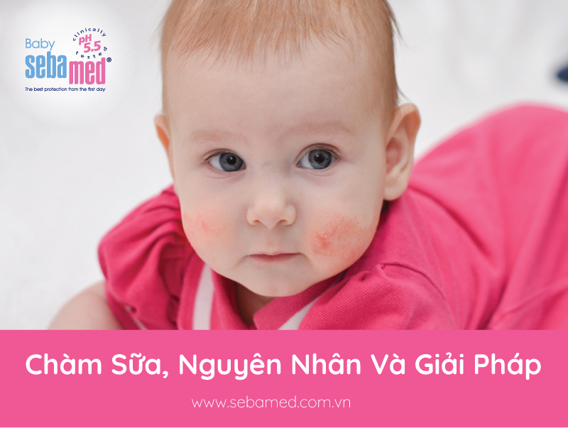 Chàm sữa: Nguyên nhân và cách điều trị cho trẻ