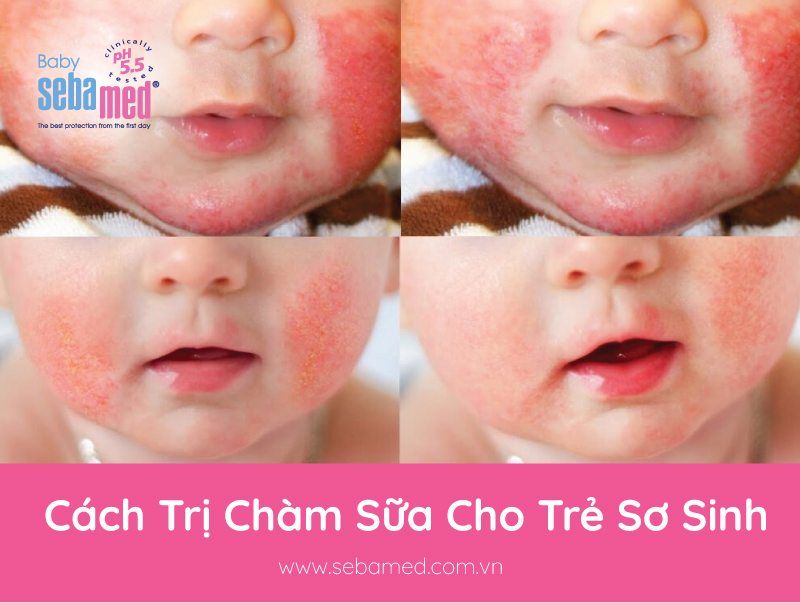 Cách Trị Chàm Sữa Cho Trẻ Sơ Sinh