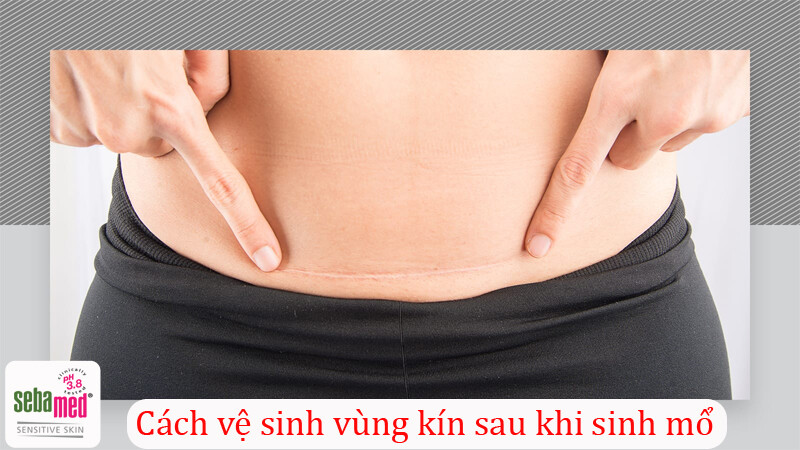 Cách vệ sinh vùng kín sau khi sinh mổ đúng cách [Cập nhật 2025]