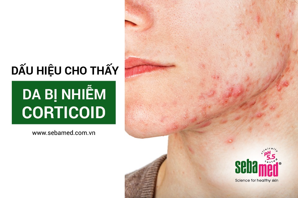 Những dấu hiệu nhận biết da nhiễm corticoid