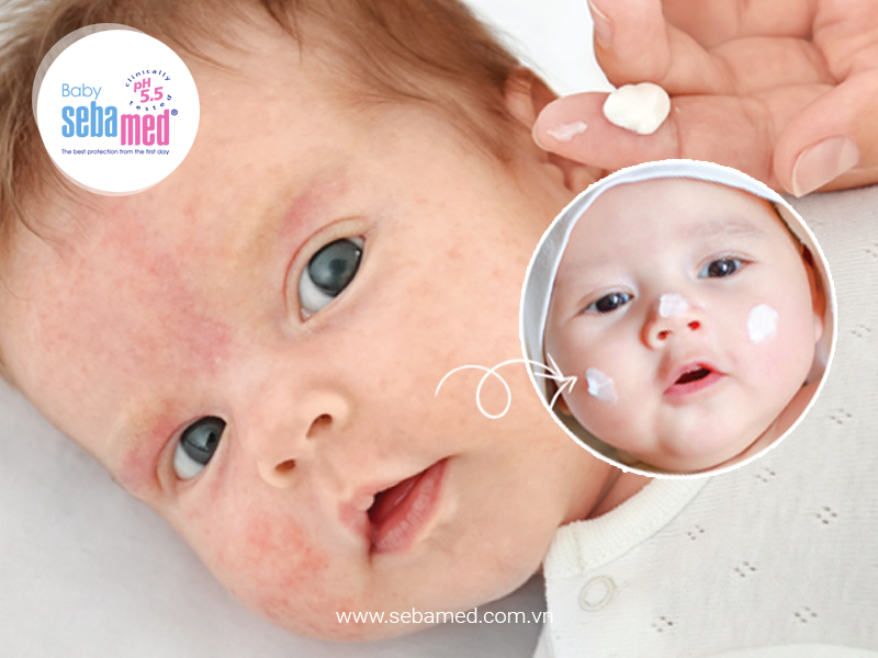 Kiểm Soát Bệnh Chàm Da Bằng Dưỡng Ẩm