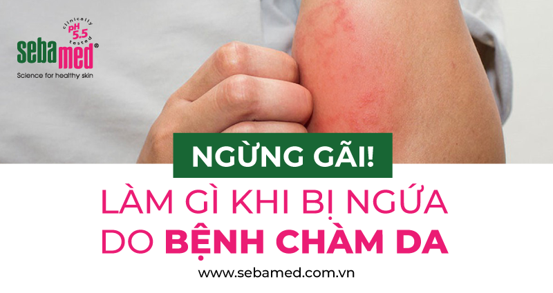 Cách giảm ngứa bệnh Chàm da chuẩn khoa học