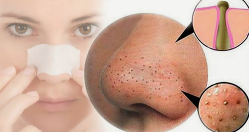 Mẹo Trị Mụn Và Se Khít Lỗ Chân Lông Hay Nhất