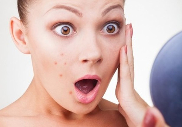 Mụn tuổi dậy thì có tự hết không?