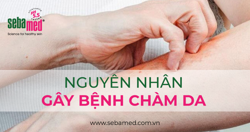 Các nguyên nhân gây bệnh Chàm da chi tiết [Cập nhật 2025]