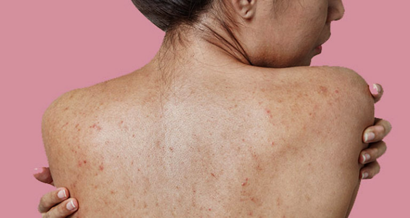 Cách trị dứt điểm mụn lưng an toàn và hiệu quả