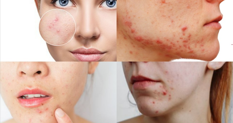 Cách trị mụn nội tiết dứt điểm nhanh chóng