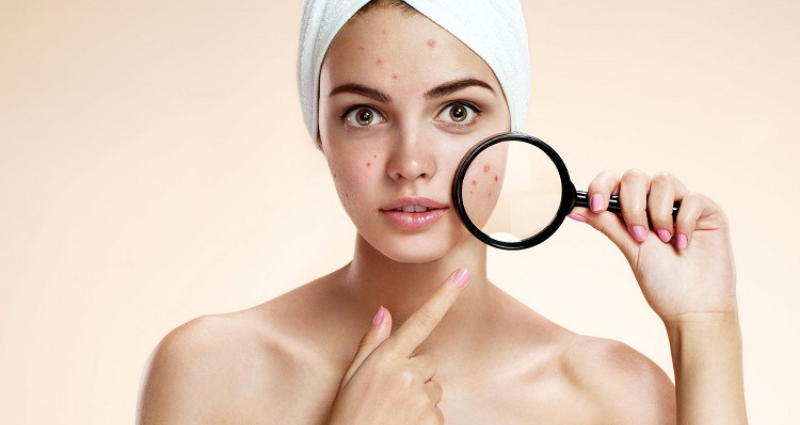 Vị trí mụn trên mặt nói lên điều gì?