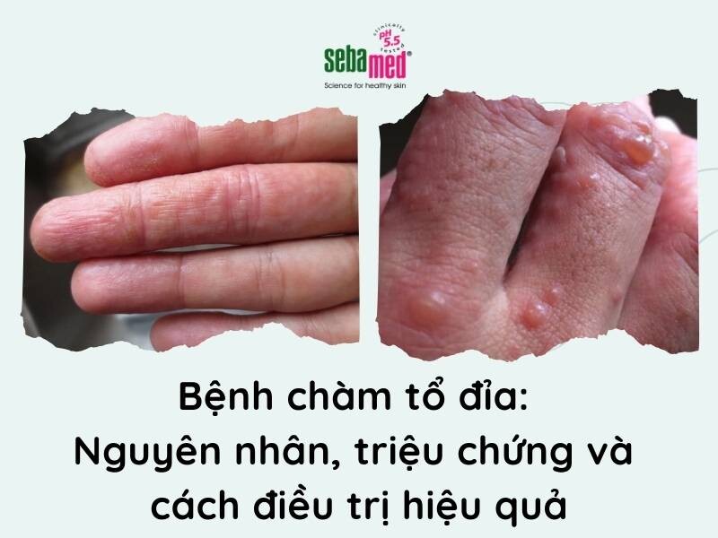 Bệnh chàm tổ đỉa: Nguyên nhân, triệu chứng và cách điều trị hiệu quả
