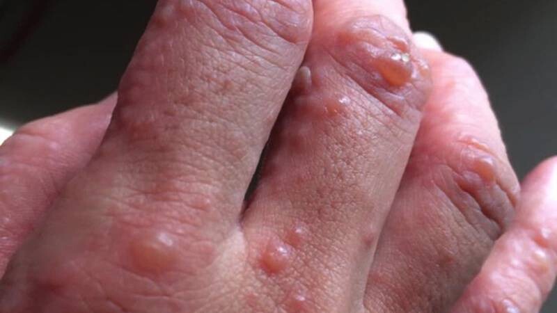Bệnh chàm tổ đỉa là gì?