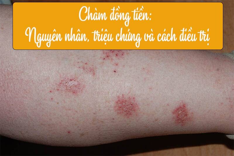 Chàm đồng tiền: Nguyên nhân, triệu chứng và cách điều trị hiệu quả